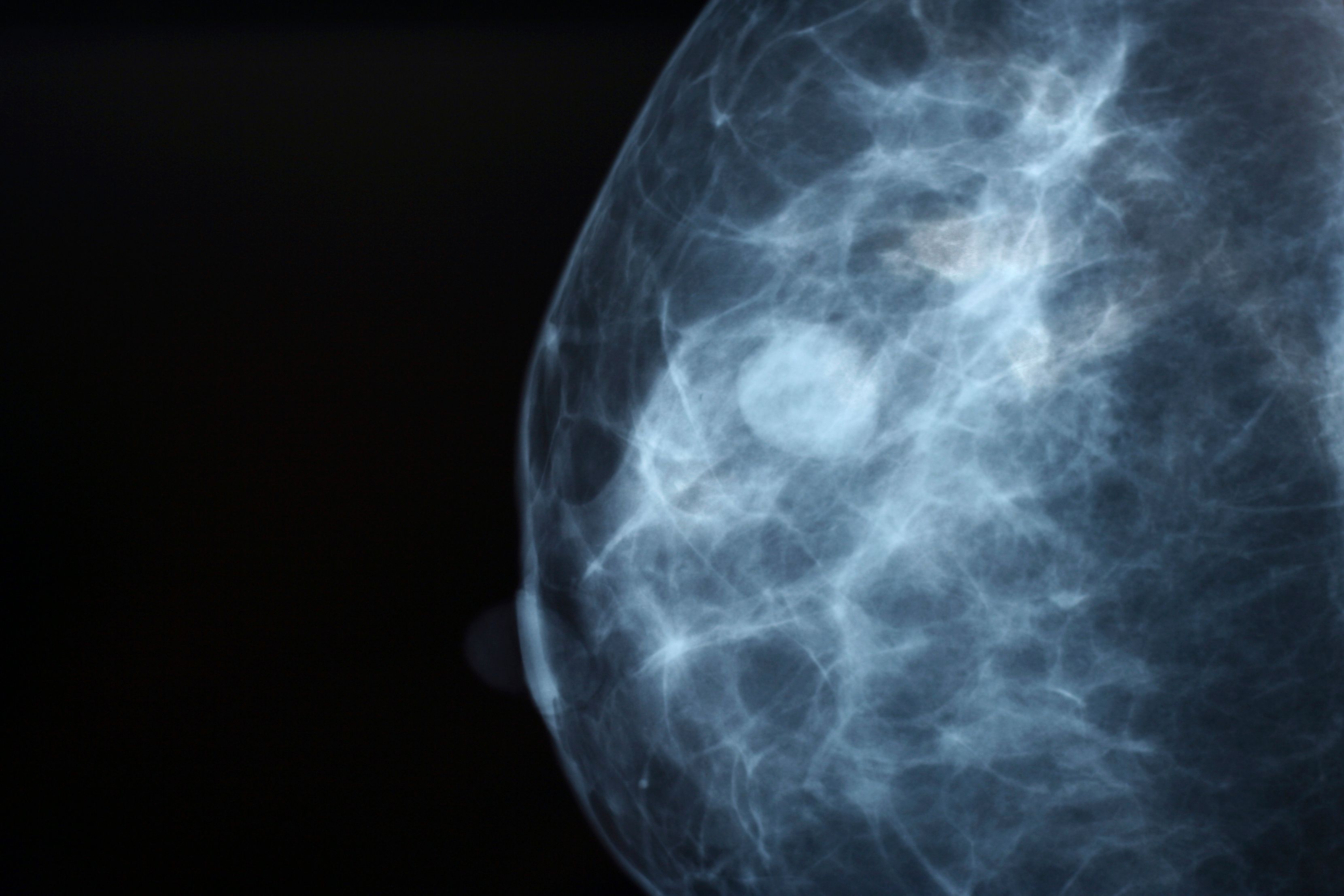 Фиброма в груди. Фиброзно-кистозная мастопатия маммография. Фиброзная мастопатия маммограмма. Кистозная мастопатия маммография. Узловая мастопатия маммограмма.