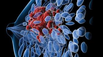breast cancer