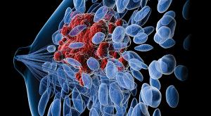 Blood-Based Markers Improve Precision Medicine in Breast Cancer