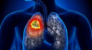 FDA ODAC Votes on Safety and Efficacy of Ramucirumab Plus Erlotinib for EGFR+ NSCLC