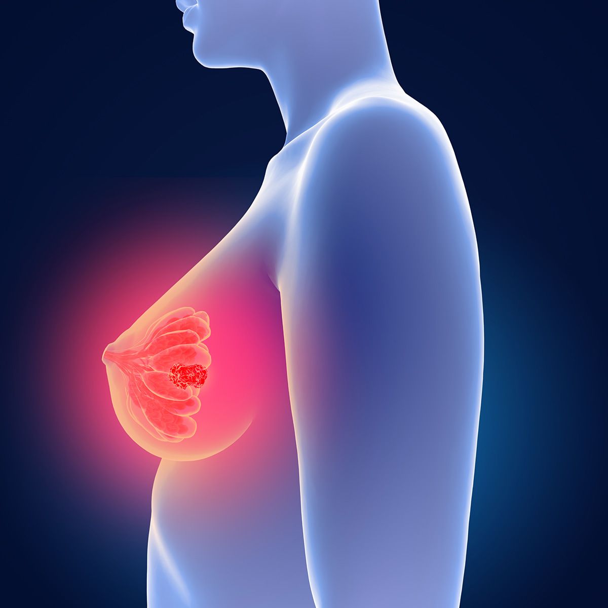 graphic of a breast with a tumor