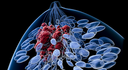 Addition of Abemaciclib to Aromatase Inhibitor Therapy Prolongs Survival in HR+/HER2- Breast Cancer