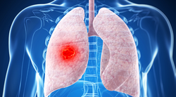 Tislelizumab Maintains Superior Overall Survival Benefit Vs Docetaxel in Pretreated NSCLC