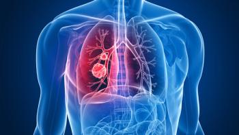 Graphic of a person with a lung tumor
