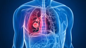 Graphic of a lung with a tumor