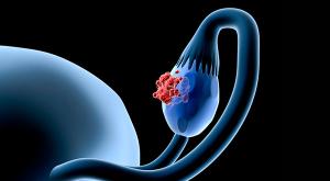 Image of an ovary with a tumor