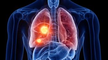 Graphic of lungs with a tumor