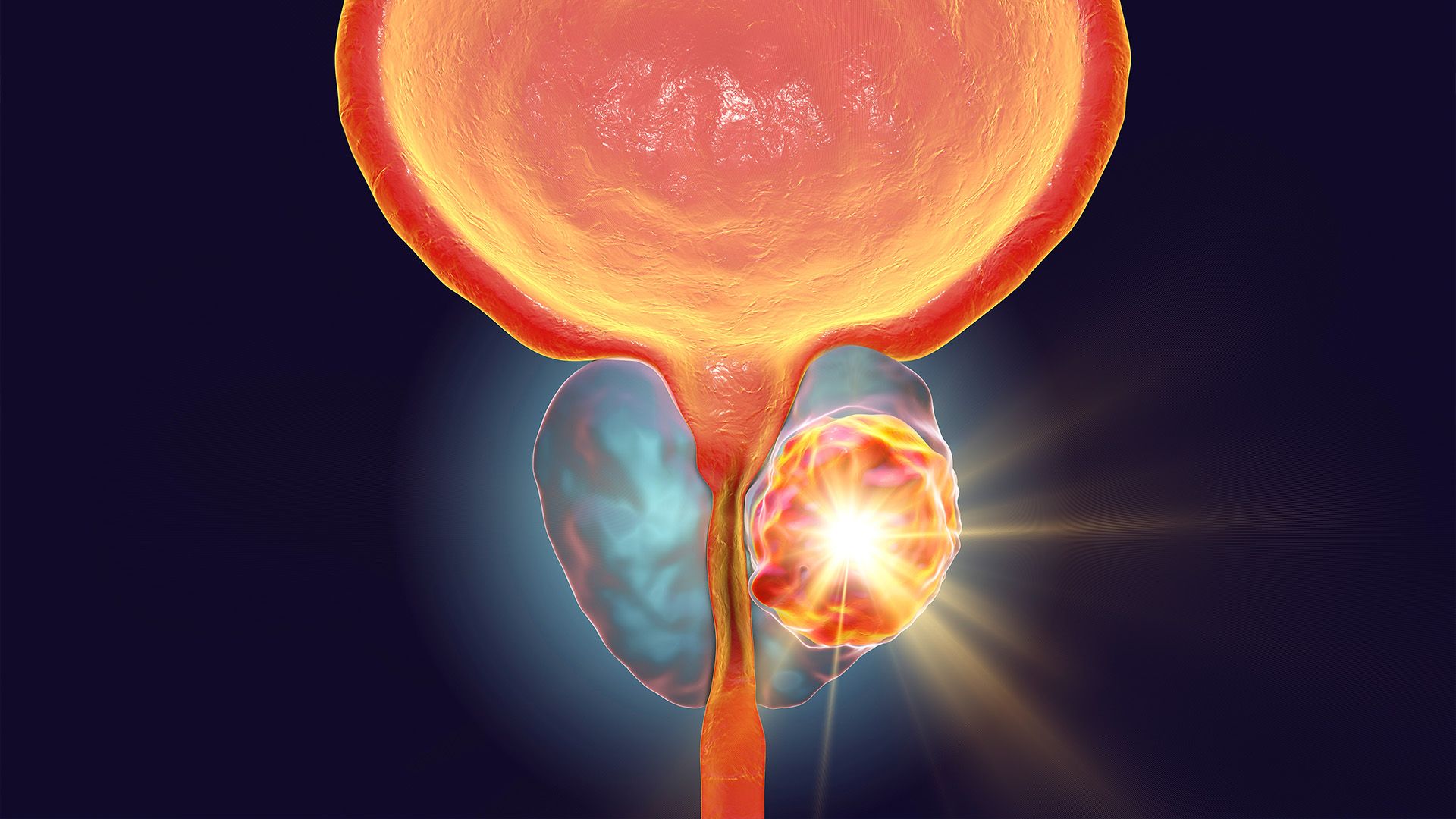 Graphic of a prostate with a tumor