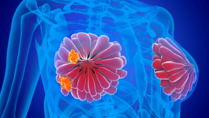 Image of a breast with metastatic cancer