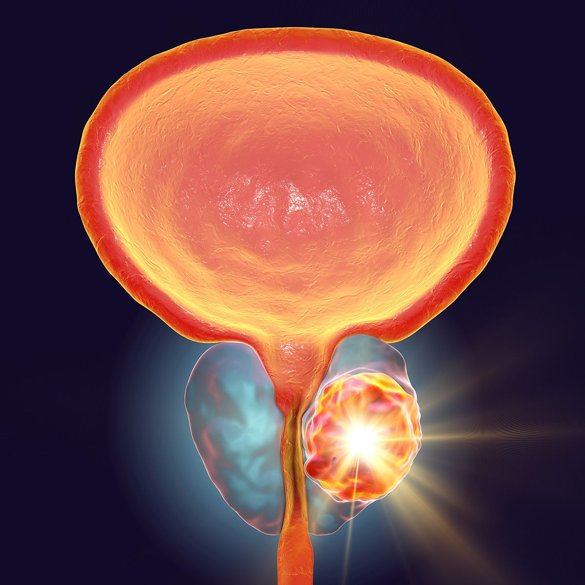 Anatomical graphic of a prostate with a large tumor