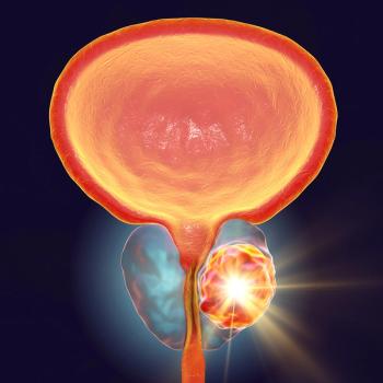 Anatomical graphic of a prostate with a large tumor
