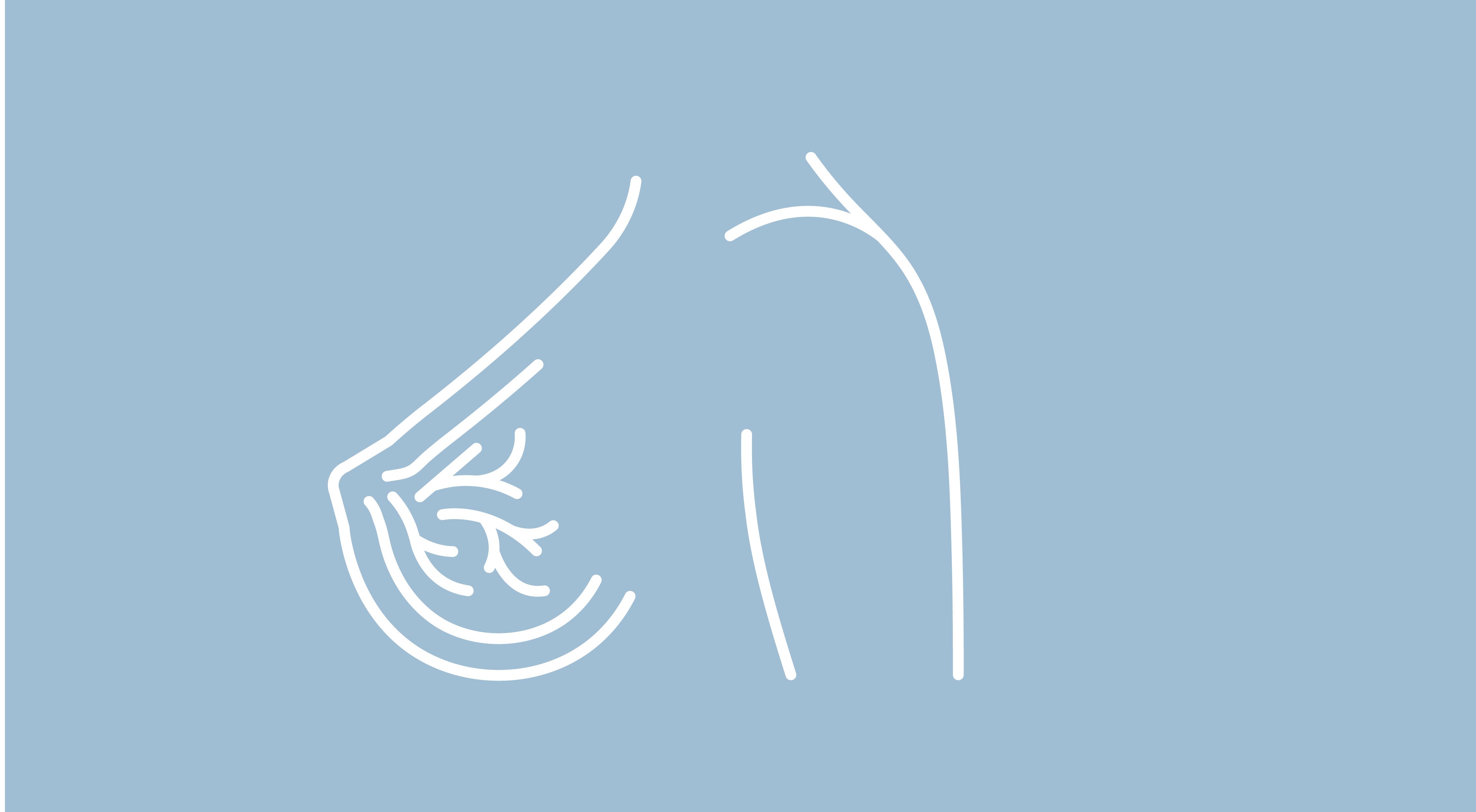 Brock Underscores doit reclasser les patientes atteintes d’un cancer du sein métastatique HER2 négatif Brock Underscores doit reclasser les patientes atteintes d’un cancer du sein métastatique HER2 négatif