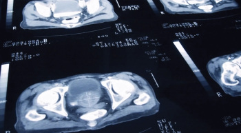 Darolutamide Extends Survival in nmCRPC Regardless of Prior RT or Radical Prostatectomy 