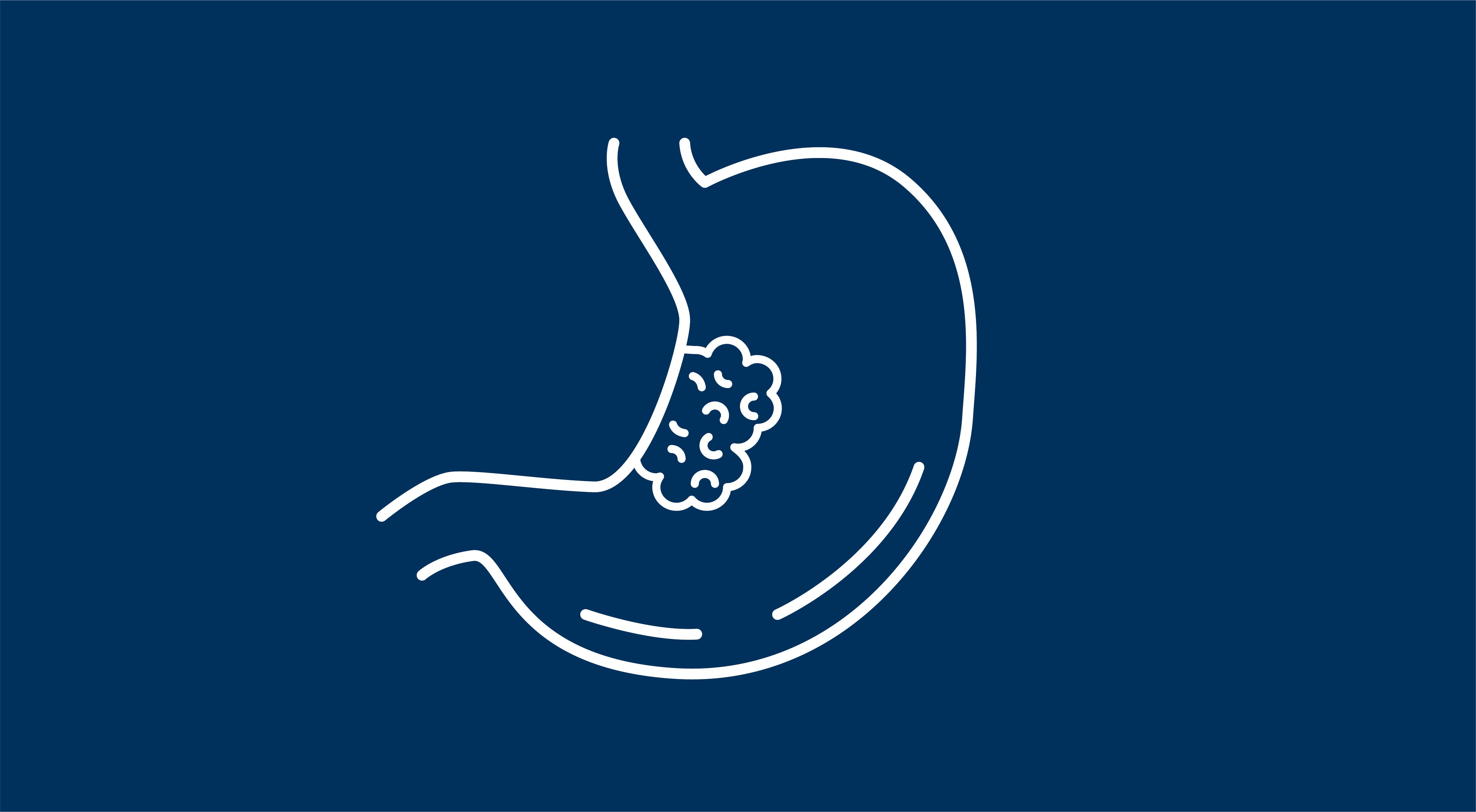 Advanced Gastric/GEJ Cancer