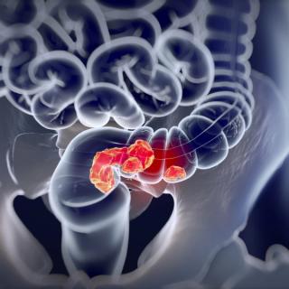 Metastatic CRC Nursing Webinar