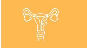 Ovarian Cancer