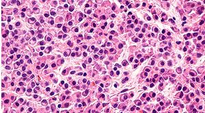 Emerging Treatments for Patients with Myeloma Prove Promising Despite Obstacles