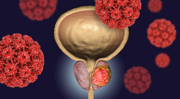 Graphic of a prostate with a tumor