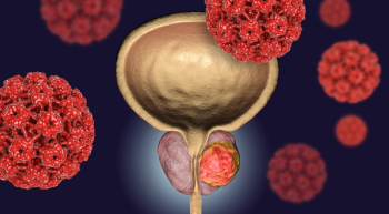 Graphic of a prostate with a tumor