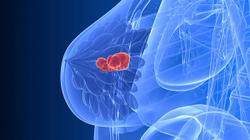 Entrectinib Generates Favorable Outcomes in NTRK Fusion+ Breast Cancer