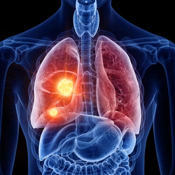 Graphic of a person with lung tumors