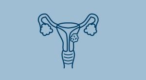 Endometrial Cancer