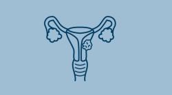 Zimberelimab Monotherapy Proves Safe, Effective in PD-L1–Positive Cervical Cancer 