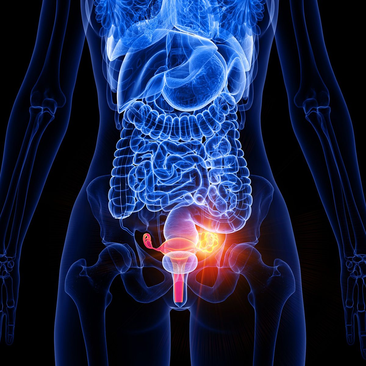 Graphic of a human body with ovarian tumors highlighted