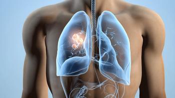 Lenvatinib-Pembrolizumab Combo May Not Improve Survival vs. Docetaxel in Stage IV NSCLC