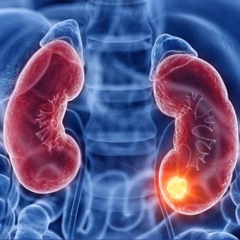 Graphic of a kidney with a tumor