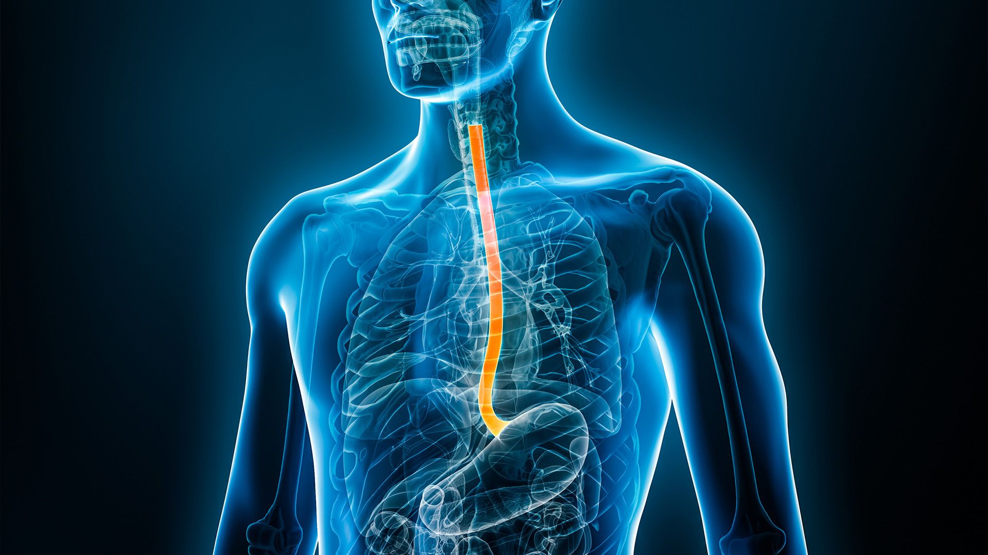 Graphic of a person's esophagus