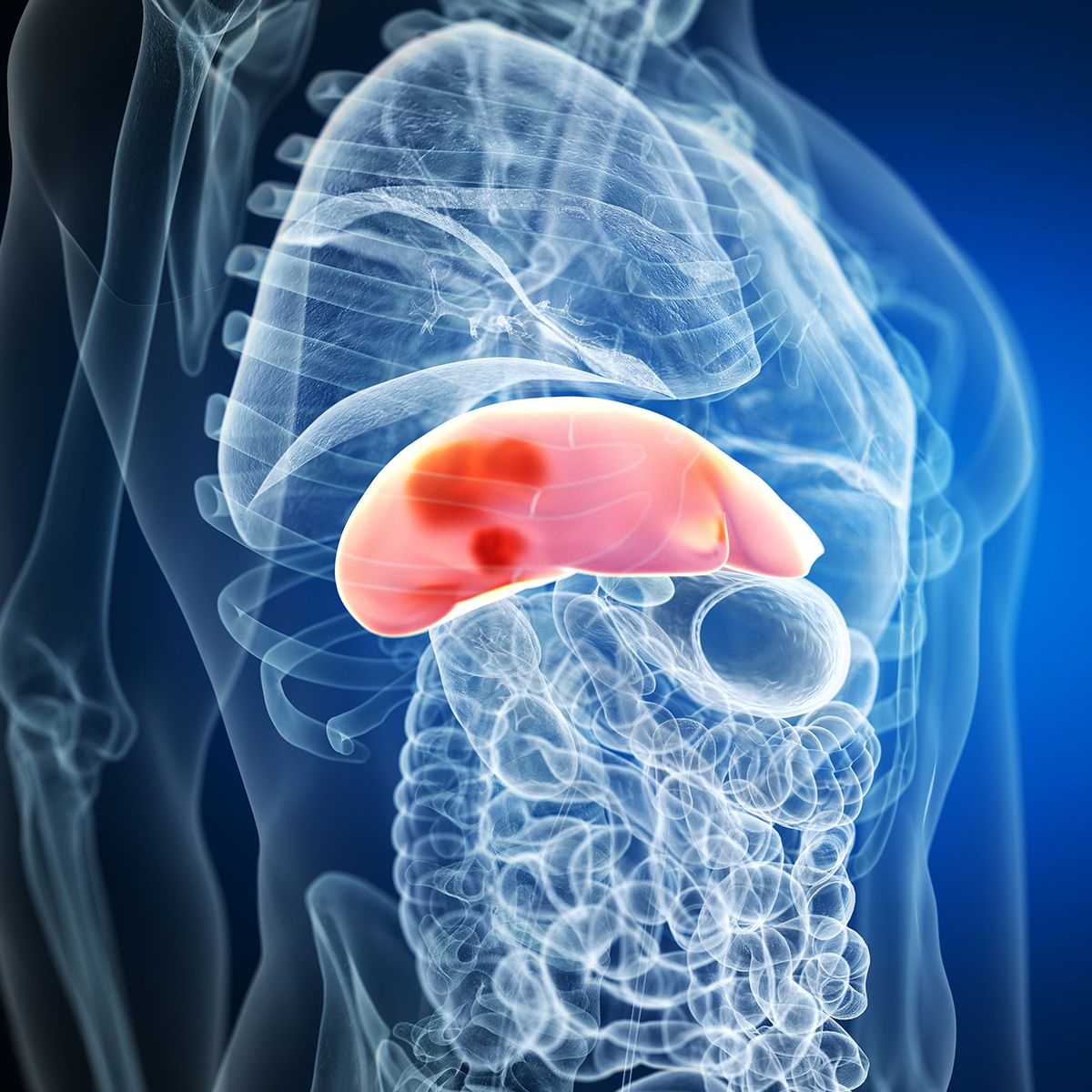 Graphic of a person with liver tumors