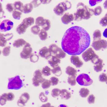 Image of bone marrow with cancer cells