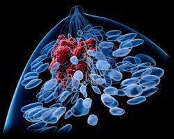 Patients With HER2+ Metastatic Breast Cancer Experience Consistent PFS Benefit With Trastuzumab Deruxtecan