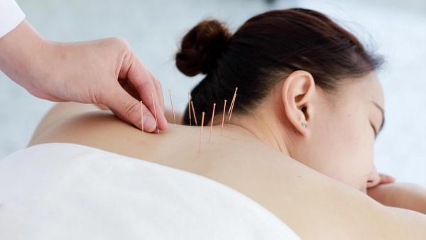 Image of a person receiving acupuncture