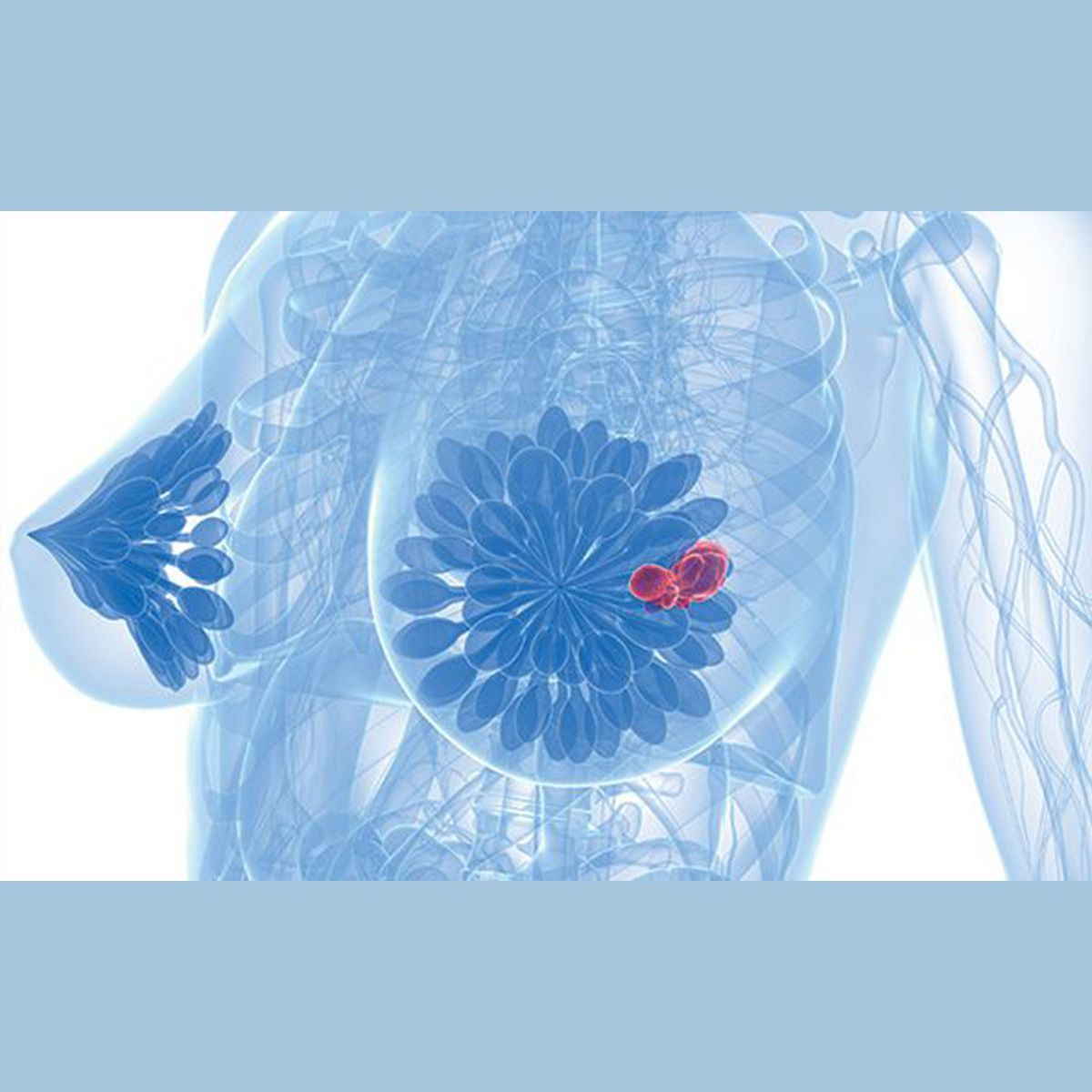 Graphic of a breast with a tumor