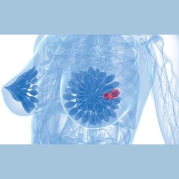 Graphic of a breast with a tumor