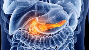 PARP Inhibitors Hit the Pancreatic Cancer Scene