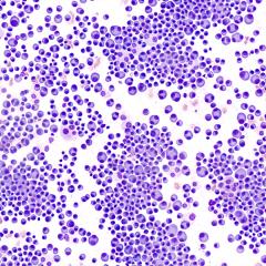 Image of multiple myeloma cells