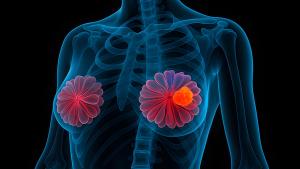 Image of a breast with a tumor