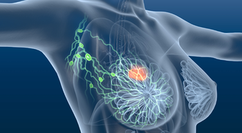 Image of a breast with tumor