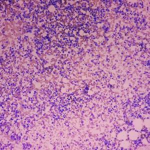 Image of multiple myeloma cells
