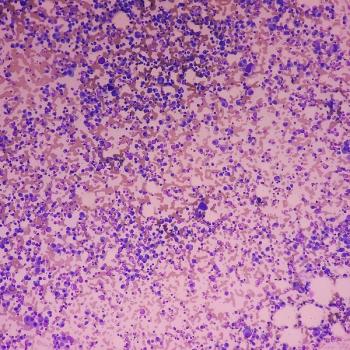 Image of bone marrow with cancer cells