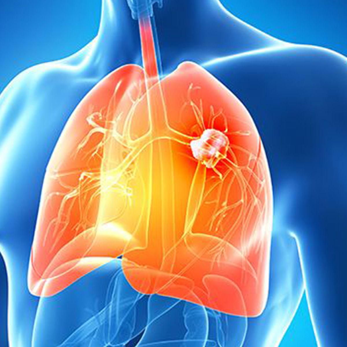 Anatomical image of a person with a tumor on their lung