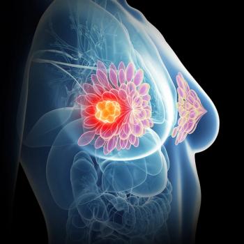 Anatomical image of a person with a breast tumor