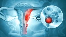 Diagram of endometrial cancer
