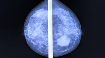 Variations in Diagnostic Mammograms Emphasizes Need for Racially and Ethnically Diverse Performance Studies