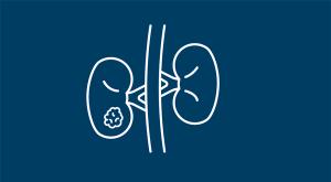 Adjuvant RCC Therapy Remains a Challenge as Treatment Landscape Continues to Evolve