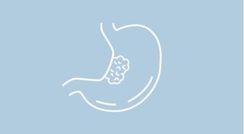 gastric cancer