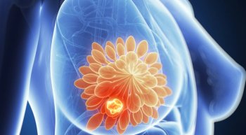 breast cancer